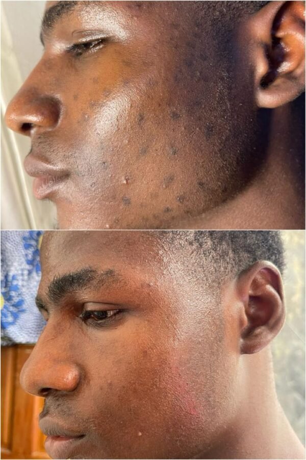 Stretch marks combo - Image 2